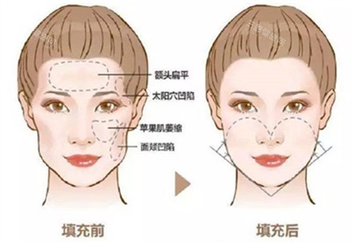 自体脂肪填充前后对比图