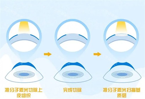 不同的近视手术 不同的近视手术