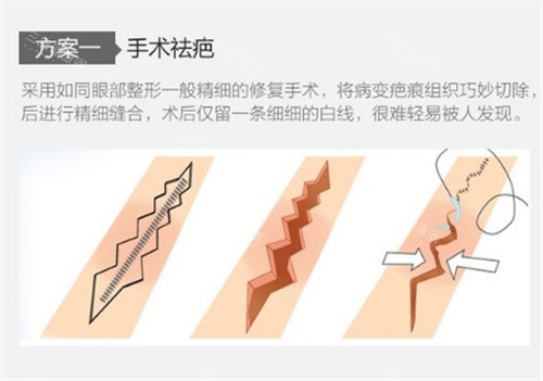 商丘韩艺手术祛疤原理图