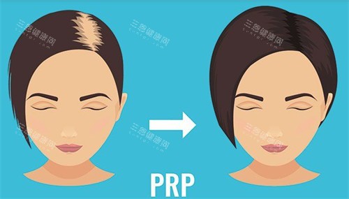 郴州臻妃植发发缝加密植发前后对比图