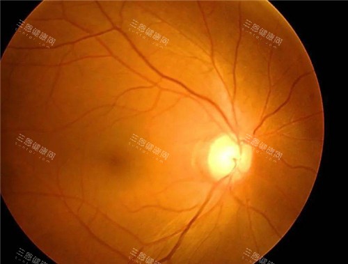 青光眼视力表现图 青光眼视力表现图