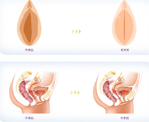 私密整形前后对比图 私密整形前后对比图