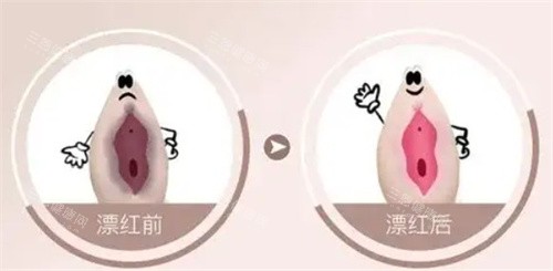 私密漂红前后 私密漂红前后