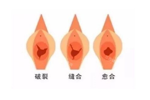 私密整形治疗图片展示 私密整形治疗图片展示