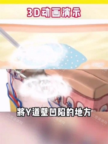 紧缩针注射阴道动画图