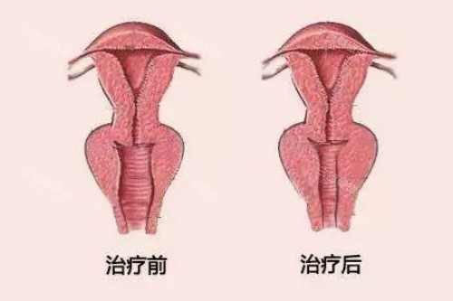 阴道紧缩卡通图 阴道紧缩卡通图
