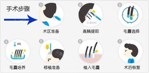 毛发移植手术步骤动画演示图