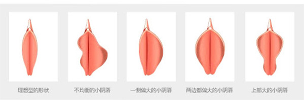 不同阴唇形状情况照片 不同阴唇形状情况照片