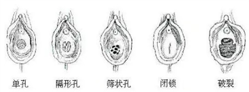 不同形状的处女膜