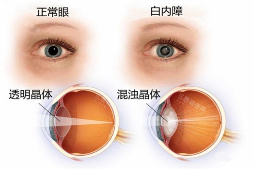 白内障与正常眼睛卡通对比图 白内障与正常眼睛卡通对比图