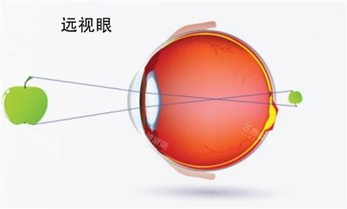 远视眼睛的视力 远视眼睛的视力
