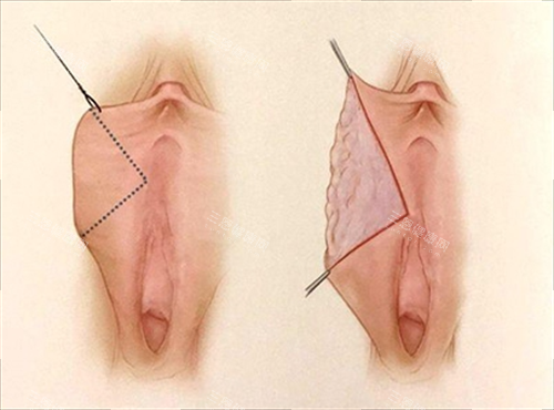 女性私密手术动画展示