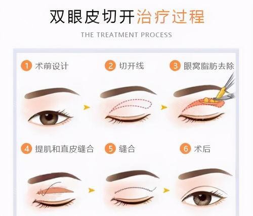 双眼皮手术方法过程图 双眼皮手术方法过程图