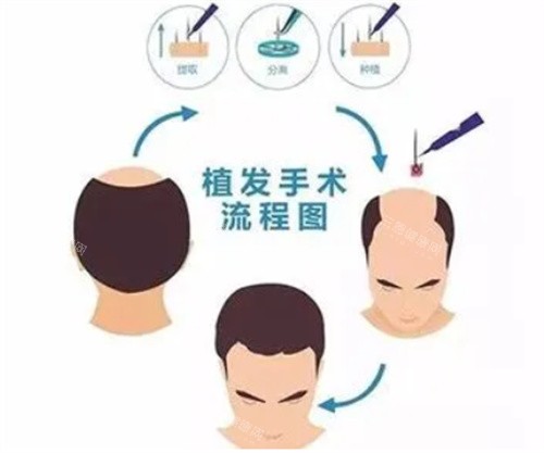 植发手术步骤图 植发手术步骤图