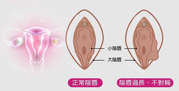 阴唇不对称改善照片