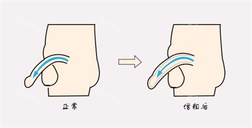 增粗术前后对比