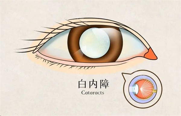 白内障怎么办 白内障怎么办