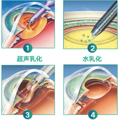 超声乳化白内障手术过程 超声乳化白内障手术过程