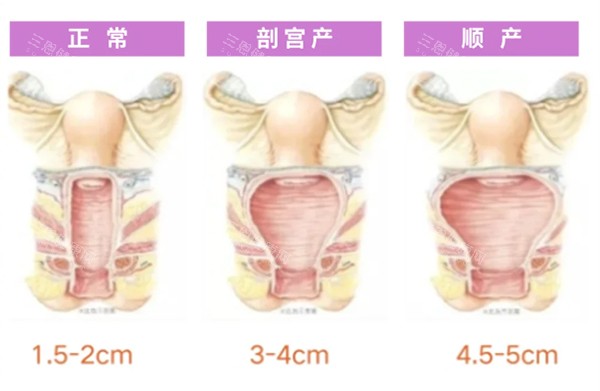 正常阴道和松弛对比照片