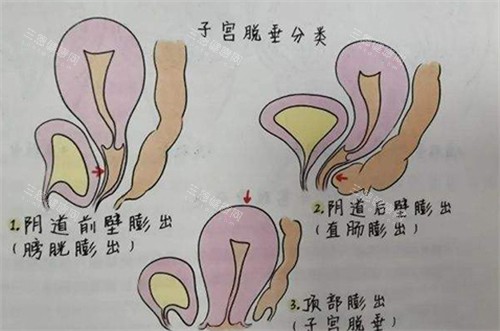 子宫脱垂的不同程度展现