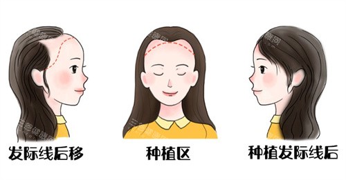 发际线后遗种植前后 发际线后遗种植前后