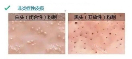 非炎症性闭口闭口黑口 非炎症性闭口闭口黑口