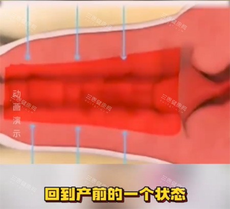 女性私密收紧针照片 女性私密收紧针照片