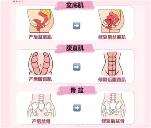 产后修复要做的项目