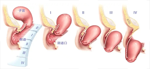 子宫脱垂程度对比图