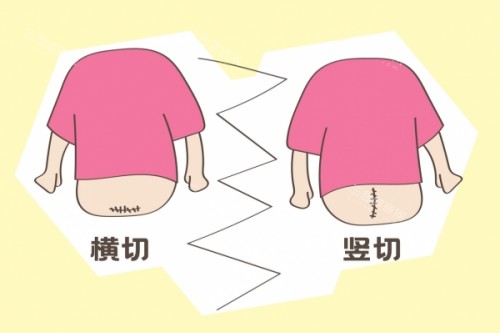 剖腹产横切竖切卡通图