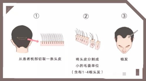 头发移植图示 头发移植图示