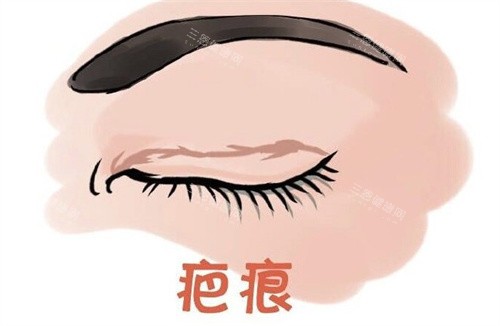 双眼皮术后疤痕 双眼皮术后疤痕