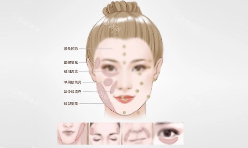 填充部位示意图