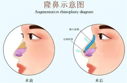 隆鼻前后对比