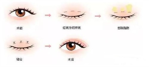 三点定位双眼皮手术过程 三点定位双眼皮手术过程