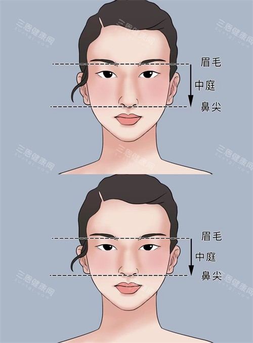 正常鼻子和过长鼻子矫正对比 正常鼻子和过长鼻子矫正对比