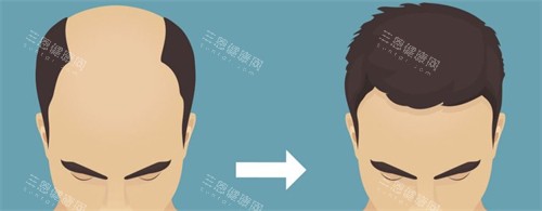 种发际线前后对比 种发际线前后对比