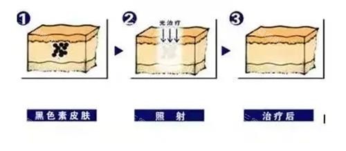激光祛雀斑的过程 激光祛雀斑的过程