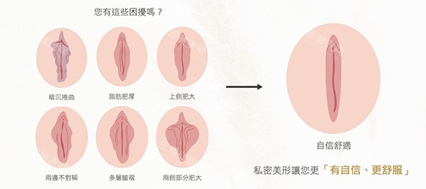 外阴阴唇整形前后变化