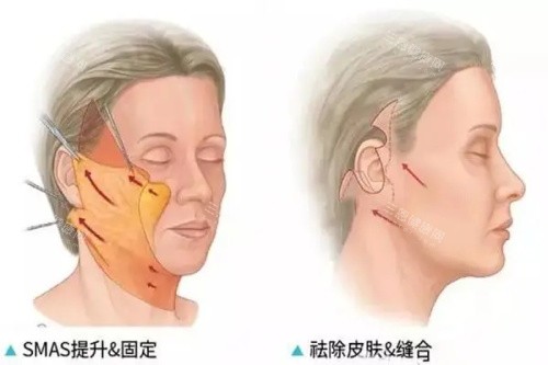 拉皮手术